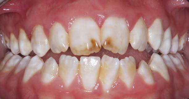 Enamel Microabrasion